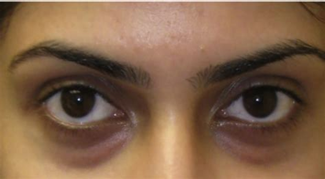 clinical treatment for dark circles in hyderabad