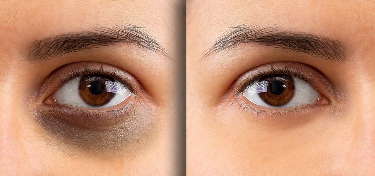 dark circles clinical treatment in hyderabad