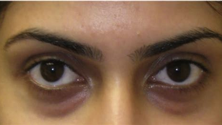 dark circles under eyes treatment clinic in hyderabad