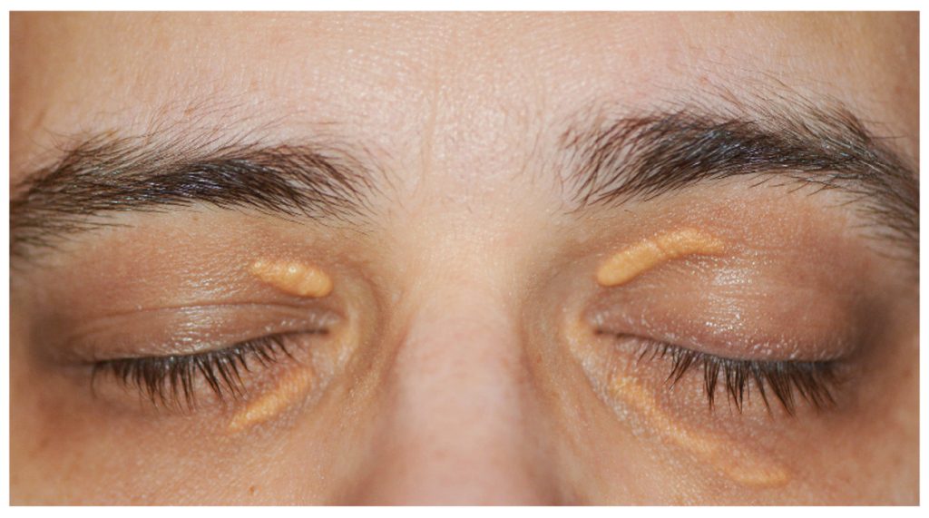 Understanding Xanthelasma The Weird Yellow Deposits On Your Eyelids