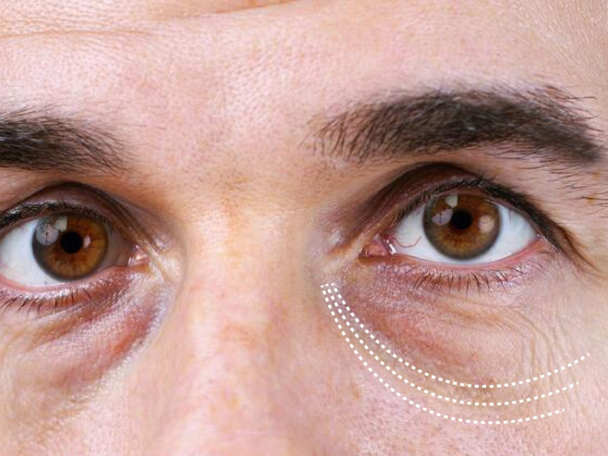 Understanding Xanthelasma: the weird yellow deposits on your eyelids!