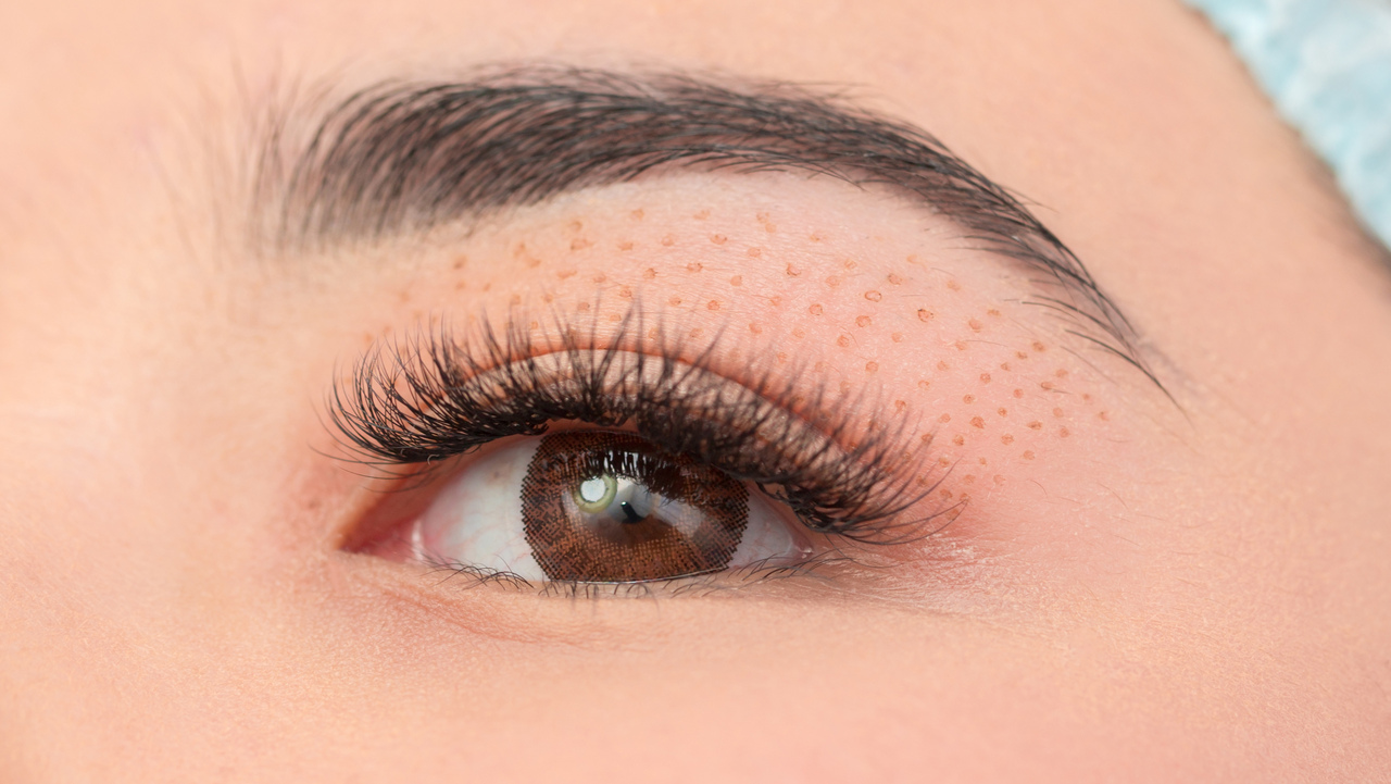 Non-Surgical Eyelifts: Saying Goodbye to Saggy Eyes Without Going Under the Knife!