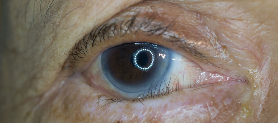 The Eye-Twist: Understanding Entropion, a Condition Where Your Eyelids Turn Inward